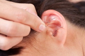 auricular-acupuncture